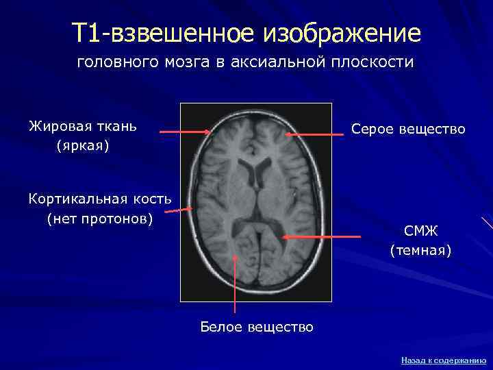 Т 1 -взвешенное изображение головного мозга в аксиальной плоскости Жировая ткань (яркая) Серое вещество