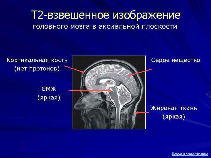 Т 2 -взвешенное изображение головного мозга в аксиальной плоскости Кортикальная кость (нет протонов) Серое