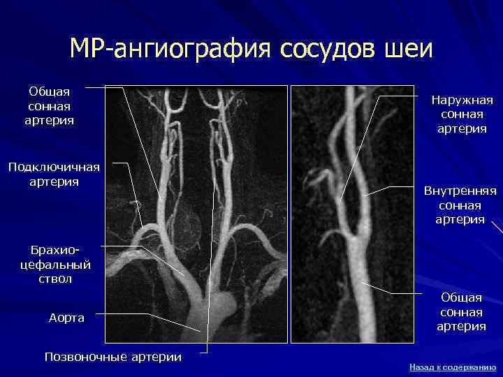 МР-ангиография сосудов шеи Общая сонная артерия Подключичная артерия Наружная сонная артерия Внутренняя сонная артерия