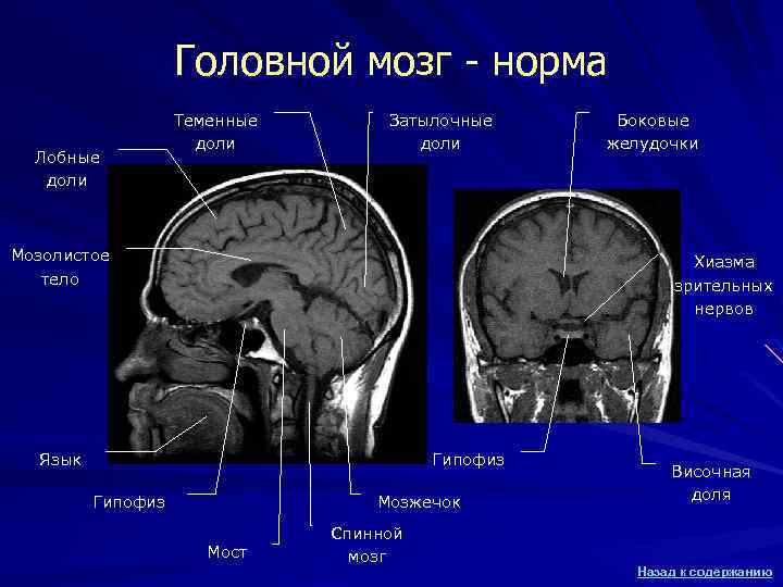 Головной мозг - норма Лобные доли Теменные доли Затылочные доли Мозолистое тело Боковые желудочки