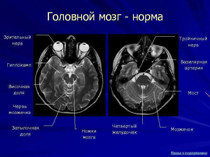Головной мозг - норма Зрительный нерв Тройничный нерв Гиппокамп Базилярная артерия Височная доля Мост