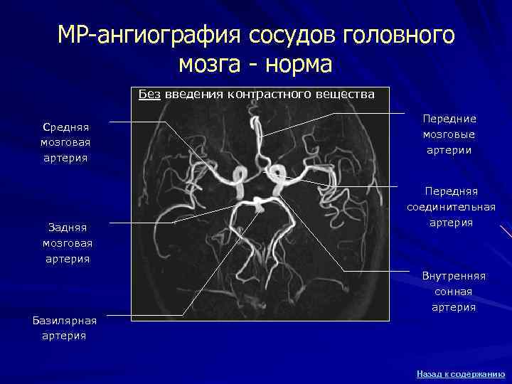МР-ангиография сосудов головного мозга - норма Без введения контрастного вещества Средняя мозговая артерия Задняя