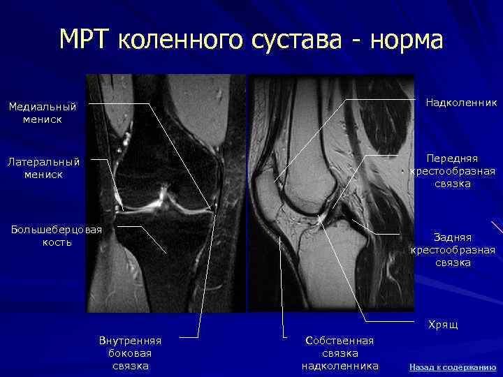 МРТ коленного сустава - норма Медиальный мениск Надколенник Латеральный мениск Передняя крестообразная связка Большеберцовая
