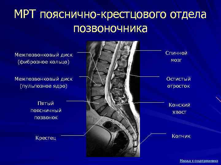 МРТ пояснично-крестцового отдела позвоночника Межпозвонковый диск (фиброзное кольцо) Спинной мозг Межпозвонковый диск (пульпозное ядро)