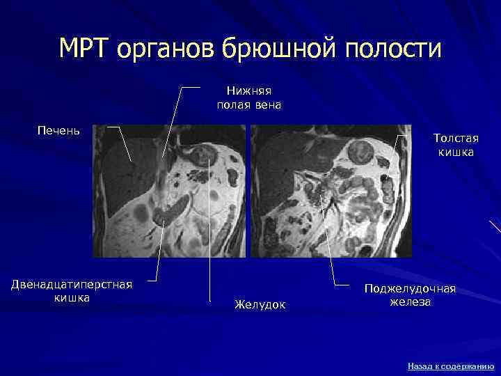 МРТ органов брюшной полости Нижняя полая вена Печень Двенадцатиперстная кишка Толстая кишка Желудок Поджелудочная