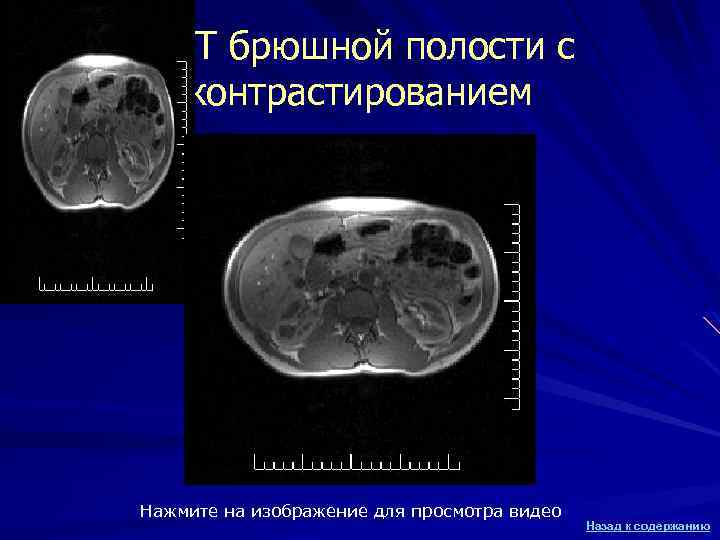 МРТ брюшной полости с контрастированием Нажмите на изображение для просмотра видео Назад к содержанию