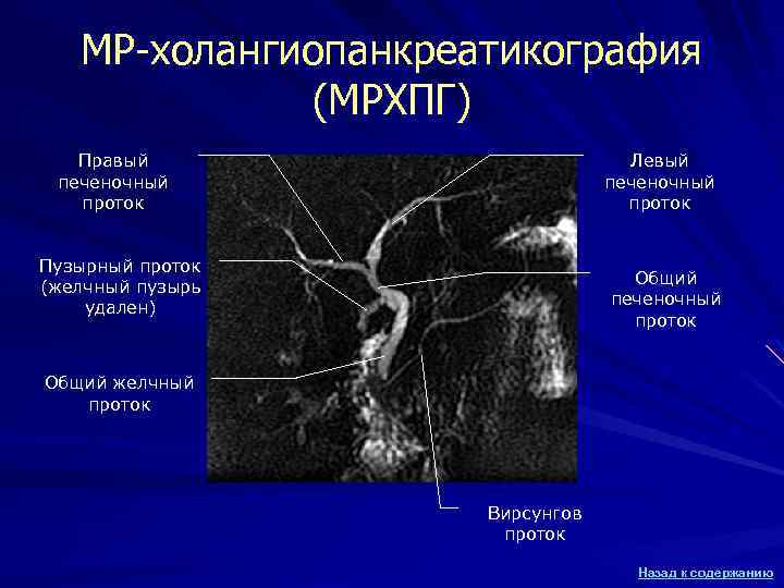МР-холангиопанкреатикография (МРХПГ) Правый печеночный проток Левый печеночный проток Пузырный проток (желчный пузырь удален) Общий
