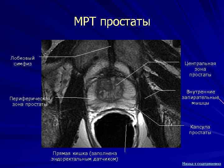 МРТ простаты Лобковый симфиз Центральная зона простаты Внутренние запирательные мышцы Периферическая зона простаты Капсула
