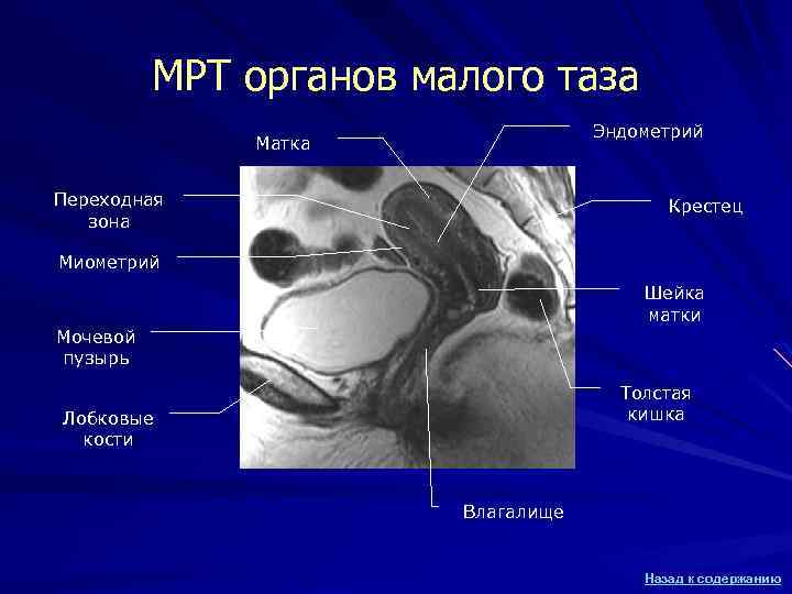 МРТ органов малого таза Эндометрий Матка Переходная зона Крестец Миометрий Шейка матки Мочевой пузырь