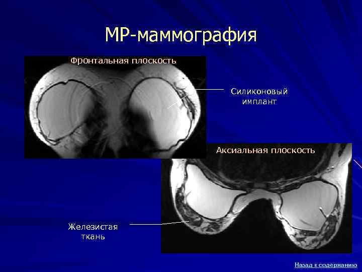 МР-маммография Фронтальная плоскость Силиконовый имплант Аксиальная плоскость Железистая ткань Назад к содержанию 