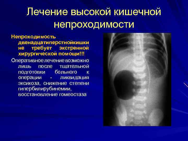 Лечение высокой кишечной непроходимости Непроходимость двенадцатиперстнойкишки не требует экстренной хирургической помощи!!! Оперативное лечение возможно