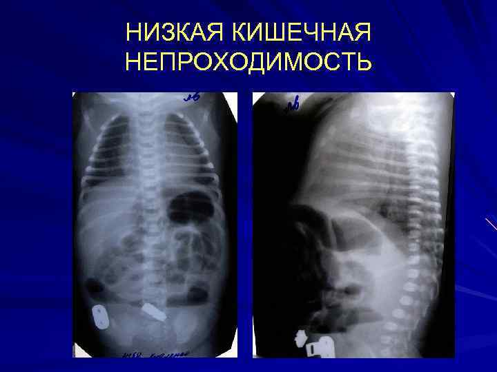 НИЗКАЯ КИШЕЧНАЯ НЕПРОХОДИМОСТЬ 