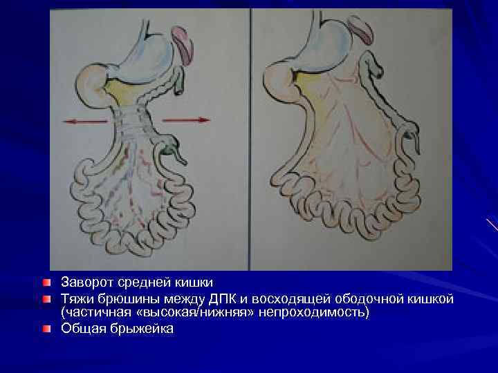 Заворот средней кишки Тяжи брюшины между ДПК и восходящей ободочной кишкой (частичная «высокая/нижняя» непроходимость)