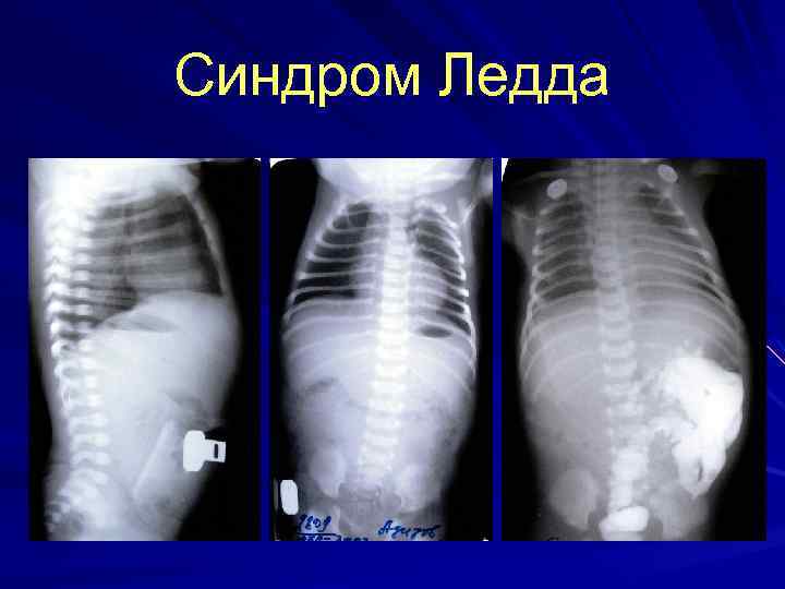 Синдром Ледда 