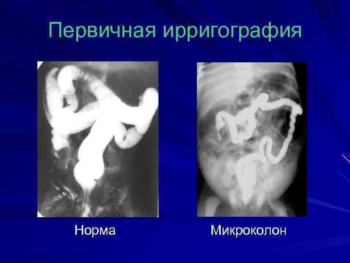 Первичная ирригография Норма Микроколон 