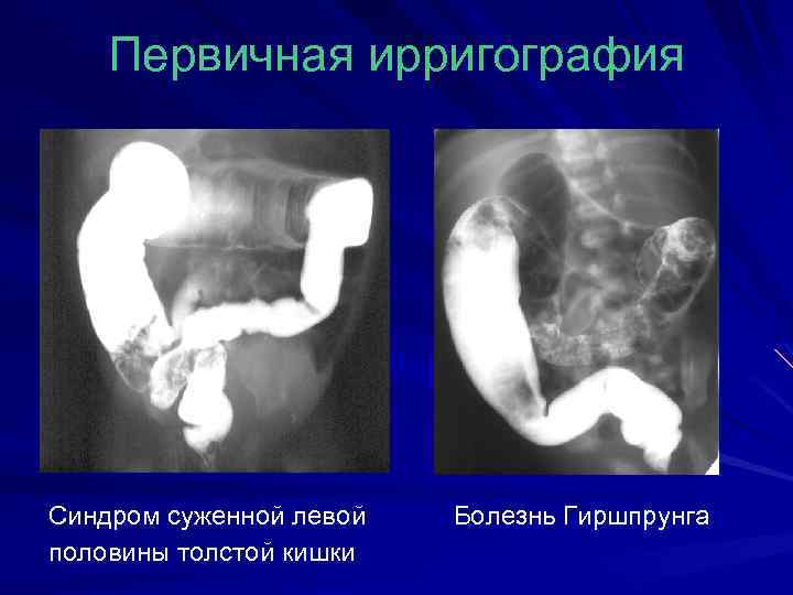 Первичная ирригография Синдром суженной левой Болезнь Гиршпрунга половины толстой кишки 