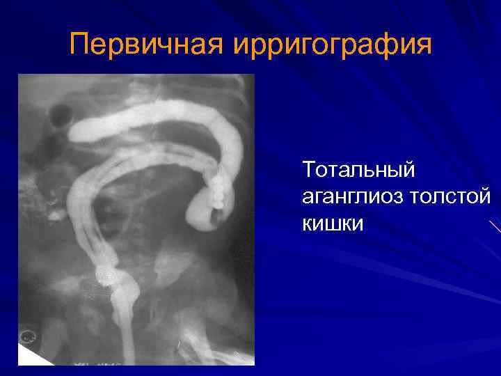 Первичная ирригография Тотальный аганглиоз толстой кишки 