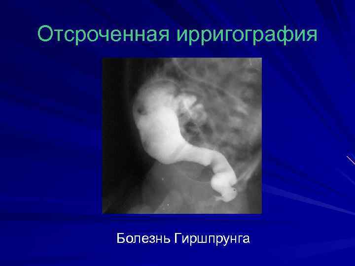 Отсроченная ирригография Болезнь Гиршпрунга 