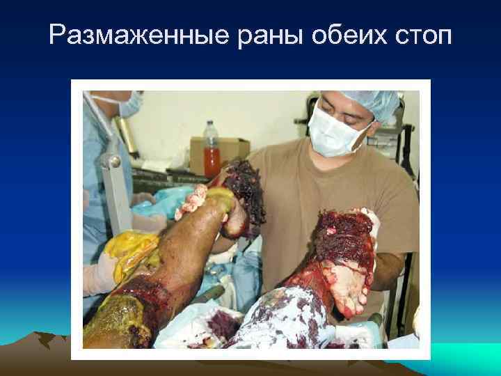 Размаженные раны обеих стоп 
