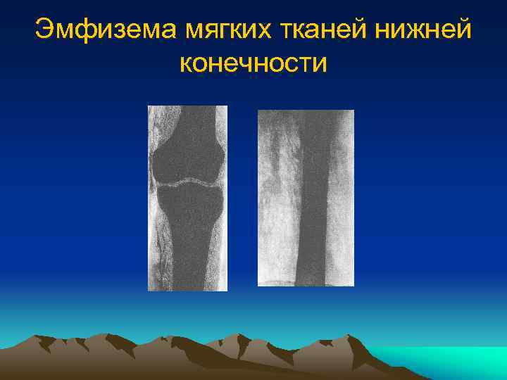 Эмфизема мягких тканей нижней конечности 