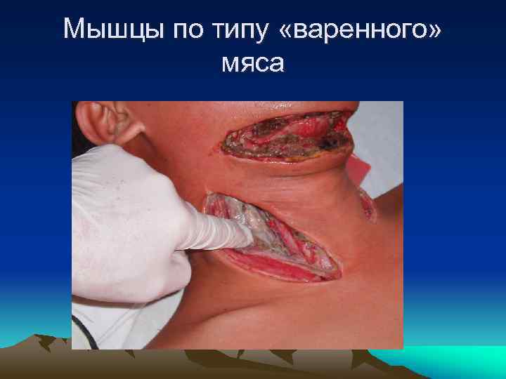 Мышцы по типу «варенного» мяса 