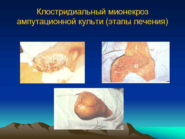 Клостридиальный мионекроз ампутационной культи (этапы лечения) 