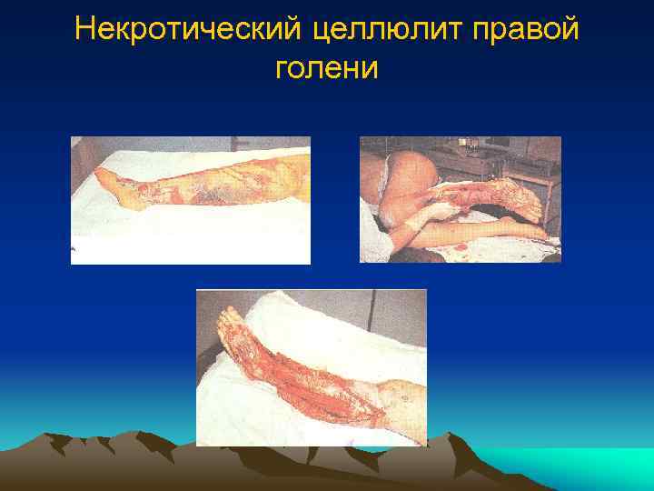 Некротический целлюлит правой голени 