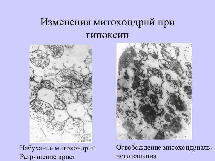 Изменения митохондрий при гипоксии Набухание митохондрий Разрушение крист Освобождение митохондриального кальция 