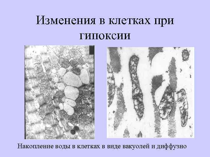 Изменения в клетках при гипоксии Накопление воды в клетках в виде вакуолей и диффузно