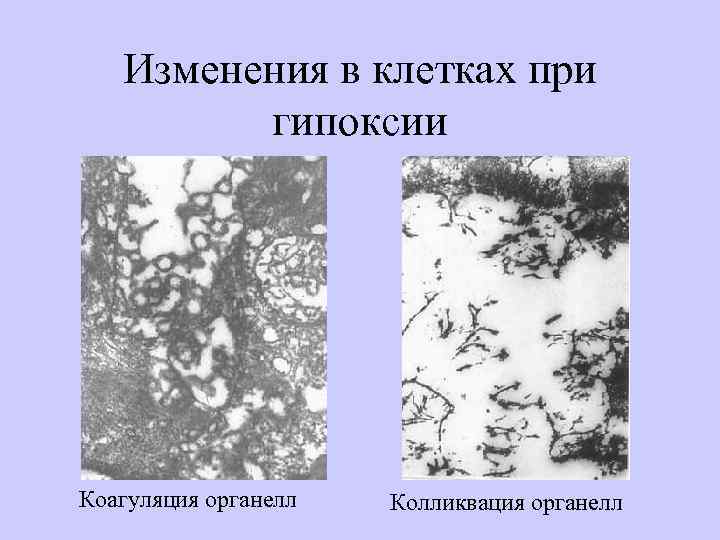Изменения в клетках при гипоксии Коагуляция органелл Колликвация органелл 
