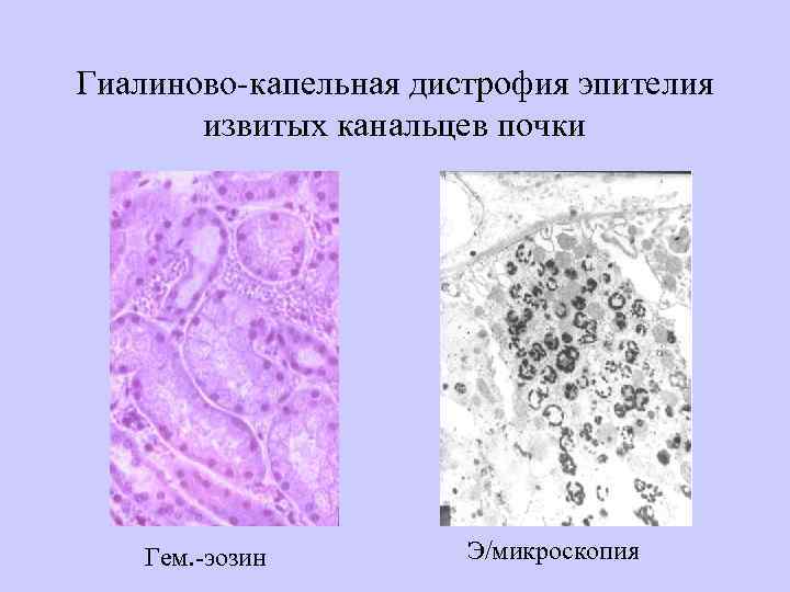 Гиалиново-капельная дистрофия эпителия извитых канальцев почки Гем. -эозин Э/микроскопия 