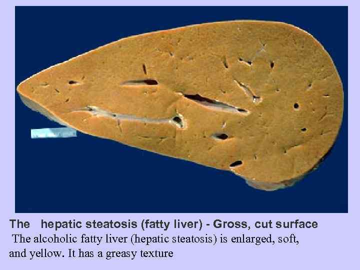 The hepatic steatosis (fatty liver) - Gross, cut surface The alcoholic fatty liver (hepatic