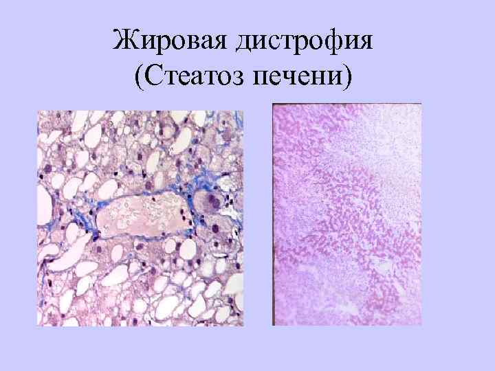 Жировая дистрофия (Стеатоз печени) 