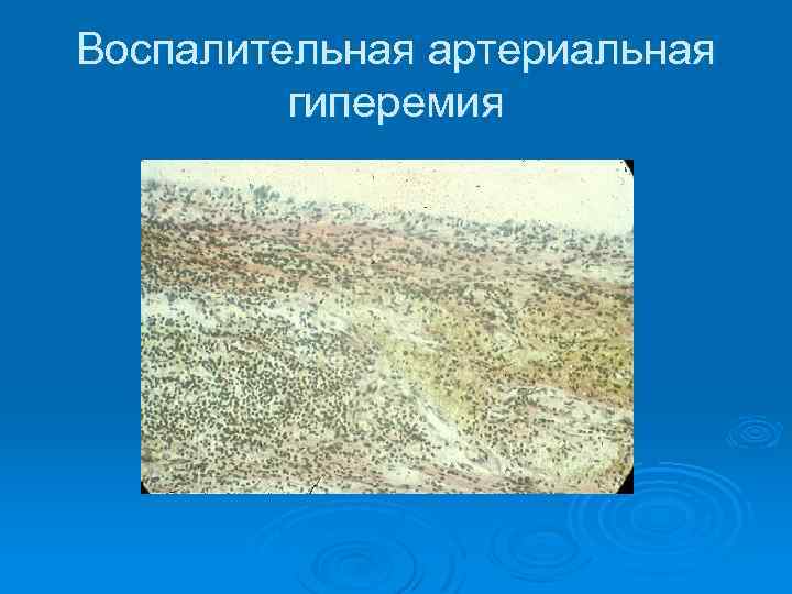 Воспалительная артериальная гиперемия 