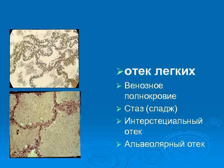 Ø отек легких Венозное полнокровие Ø Стаз (сладж) Ø Интерстециальный отек Ø Альвеолярный отек