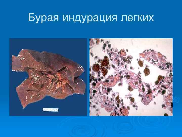 Бурая индурация легких 