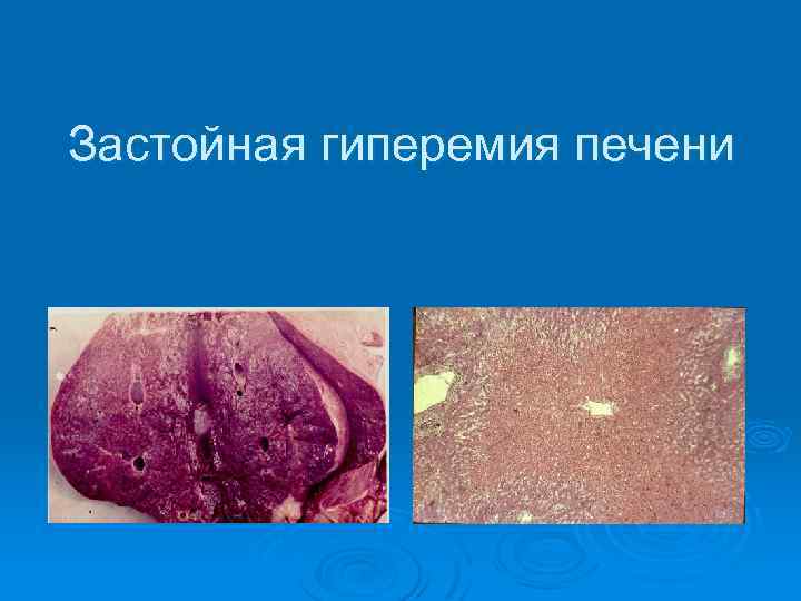 Застойная гиперемия печени 