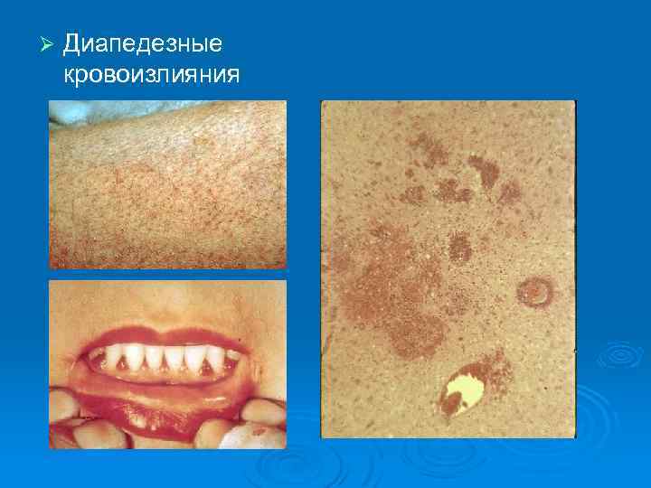 Ø Диапедезные кровоизлияния 