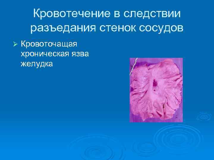 Кровотечение в следствии разъедания стенок сосудов Ø Кровоточащая хроническая язва желудка 