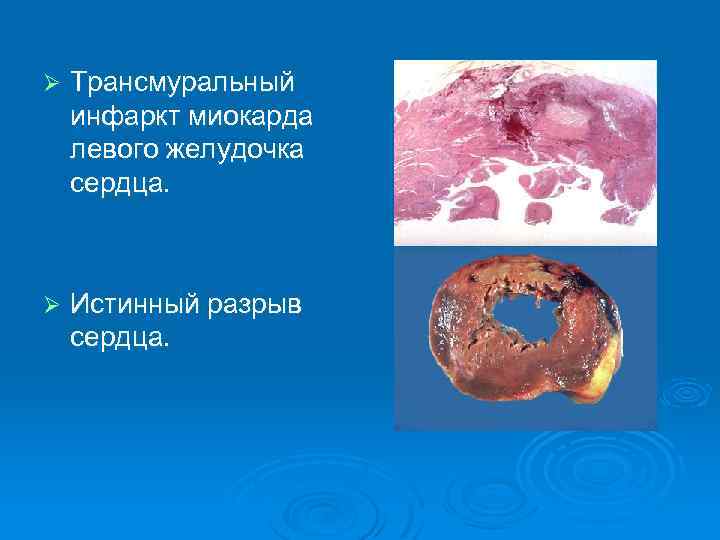 Ø Трансмуральный инфаркт миокарда левого желудочка сердца. Ø Истинный разрыв сердца. 