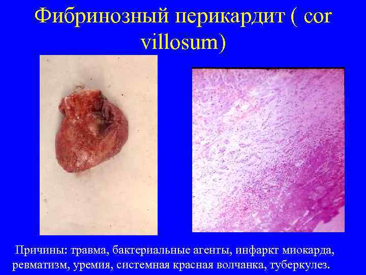 Фибринозный перикардит ( cor villosum) Причины: травма, бактериальные агенты, инфаркт миокарда, ревматизм, уремия, системная