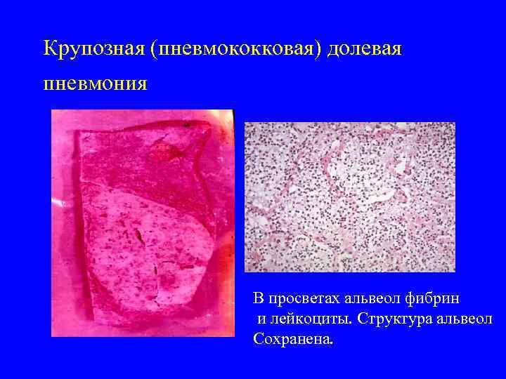 Крупозная (пневмококковая) долевая пневмония В просветах альвеол фибрин и лейкоциты. Структура альвеол Сохранена. 