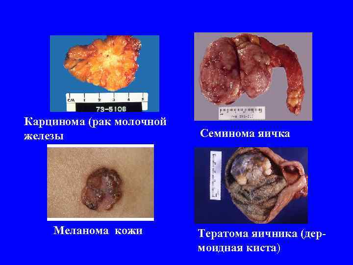 Карцинома (рак молочной железы Меланома кожи Семинома яичка Тератома яичника (дермоидная киста) 