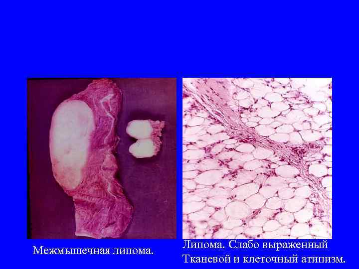 Межмышечная липома. Липома. Слабо выраженный Тканевой и клеточный атипизм. 