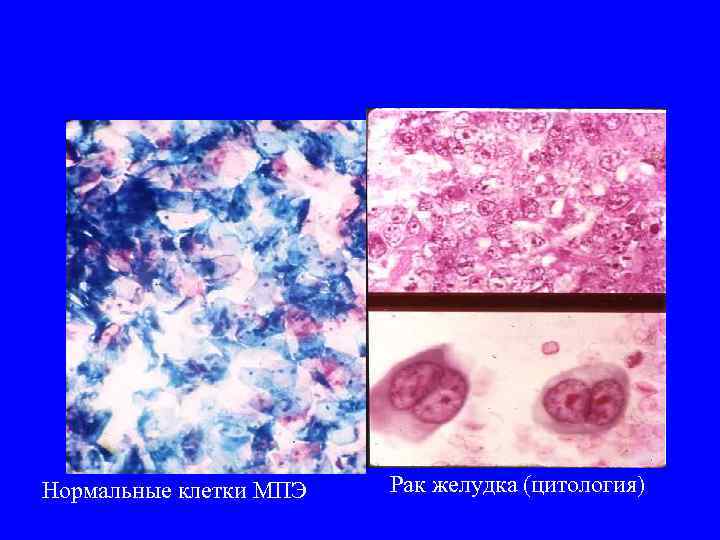 Нормальные клетки МПЭ Рак желудка (цитология) 