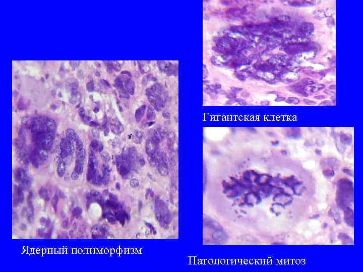 Гигантская клетка Ядерный полиморфизм Патологический митоз 