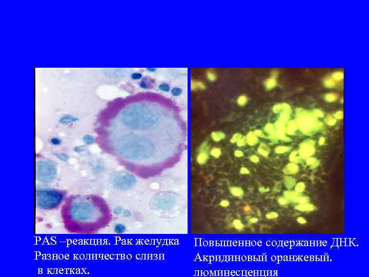 PAS –реакция. Рак желудка Разное количество слизи в клетках. Повышенное содержание ДНК. Акридиновый оранжевый.