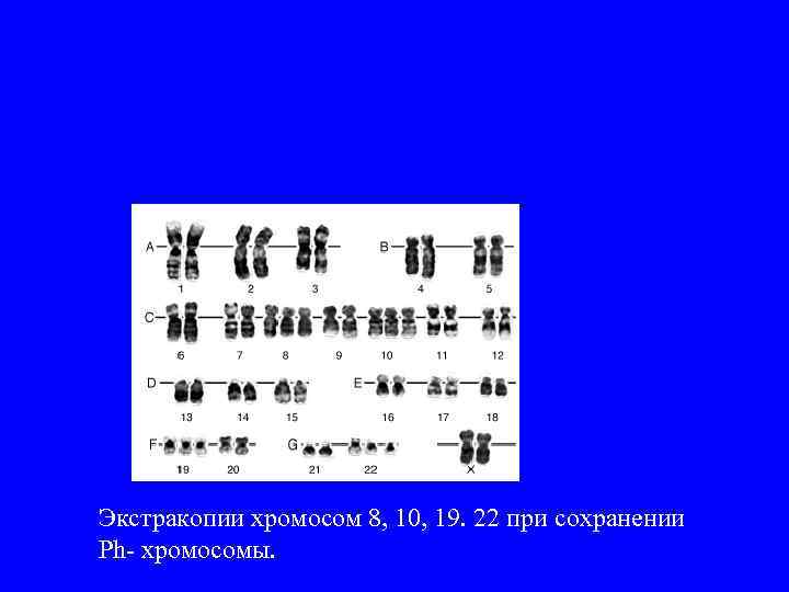 Экстракопии хромосом 8, 10, 19. 22 при сохранении Ph- хромосомы. 
