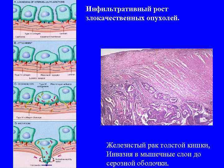 Межмышечная липома фото