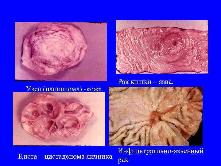Узел (папиллома) -кожа Рак кишки – язва. Инфильтративно-язвенный Киста – цистаденома яичника рак 